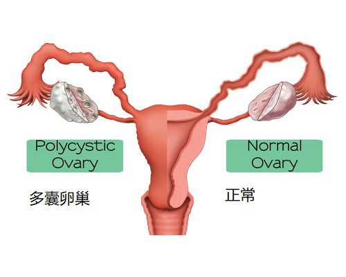 子宫后位患者赴美试管助孕：胚胎移植是否受影响？